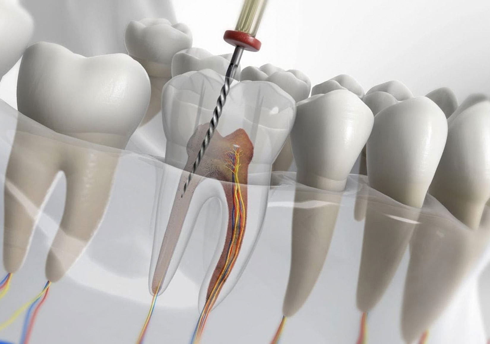 علاج قناة الجذر (Endodontics)