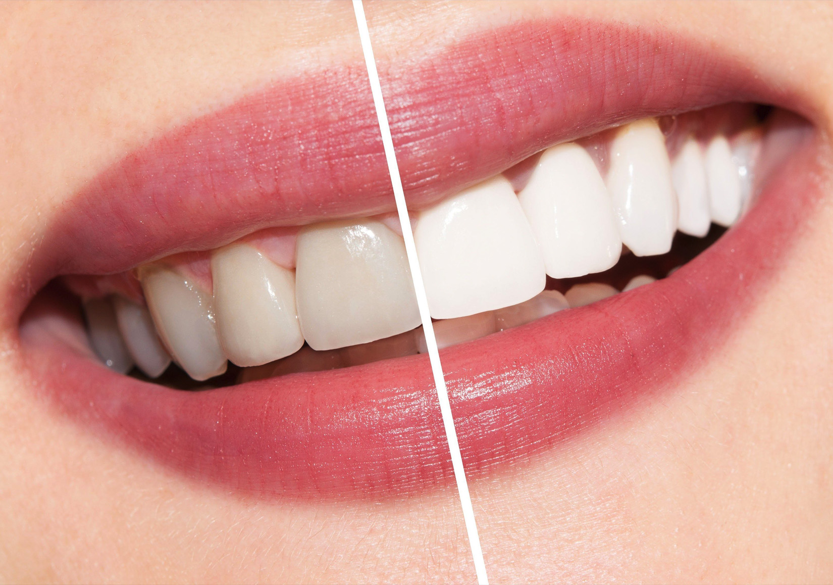 تبييض الأسنان (Bleaching)